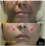 تزریق بوتاکس و تزریق چربی، لیزر موهای زائد، میکرونیدلینگ پوست