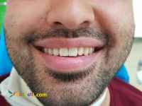  ایمپلنت و زیبایی ،( اقساط)