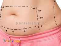 جراحی زیبایی ابدومینوپلاستی
