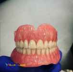 ساخت انواع دندان مصنوعی