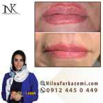 ریموو تاتو خط لب فقط در یک جلسه