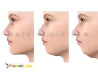 جراحی لیپوماتیک شکم