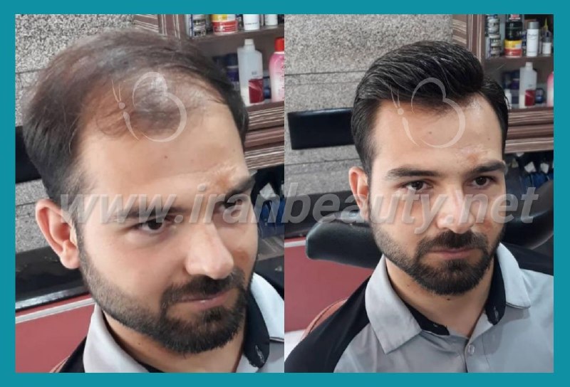مرکز تخصصی ترمیم مو و زیبایی ایران بیوتی | بهترین کلینیک ترمیم موی سر در تهران | جدیدترین روش های ترمیم مو | ترمیم مو با کلاه گیس با موی طبیعی | ترمیم مو hrt | آدرس ترمیم مو به روش اچ آر تی ترمیم مو  | ترمیم مو فیکس آلمان | پروتز مو