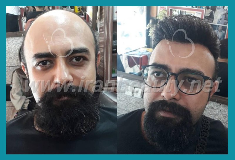 مرکز تخصصی ترمیم مو و زیبایی ایران بیوتی | بهترین کلینیک ترمیم موی سر در تهران | جدیدترین روش های ترمیم مو | ترمیم مو با کلاه گیس با موی طبیعی | ترمیم مو hrt | آدرس ترمیم مو به روش اچ آر تی ترمیم مو  | ترمیم مو فیکس آلمان | پروتز مو